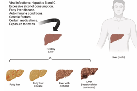  Factors and stages in the progression of liver disease