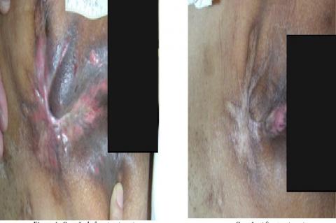 Case 1 ; before treatment, Case 1 ; After treatment